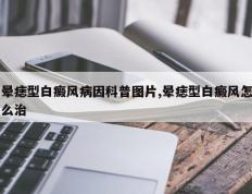 晕痣型白癜风病因科普图片,晕痣型白癜风怎么治