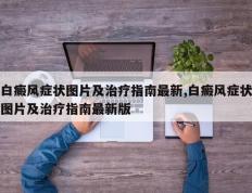白癜风症状图片及治疗指南最新,白癜风症状图片及治疗指南最新版