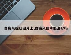 白癜风症状图片上,白癜风图片能治好吗