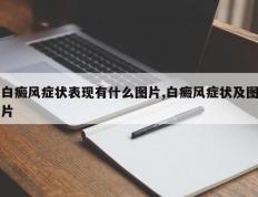 白癜风症状表现有什么图片,白癜风症状及图片