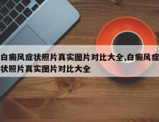 白癜风症状照片真实图片对比大全,白癜风症状照片真实图片对比大全