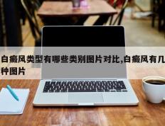 白癜风类型有哪些类别图片对比,白癜风有几种图片