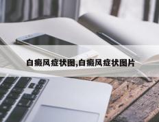 白癜风症状图,白癜风症状图片