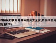白癜风症状照片真实图片大全女,白癜风图片能治好吗