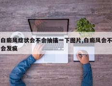 白癜风症状会不会抽搐一下图片,白癜风会不会发疯