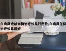 白癜风症状如何治疗效果好图片,白癜风怎样治疗效果最好