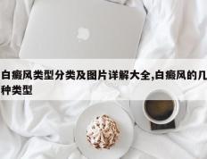 白癜风类型分类及图片详解大全,白癜风的几种类型