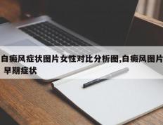白癜风症状图片女性对比分析图,白癜风图片 早期症状