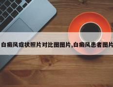 白癜风症状照片对比图图片,白癜风患者图片