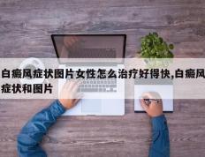白癜风症状图片女性怎么治疗好得快,白癜风症状和图片