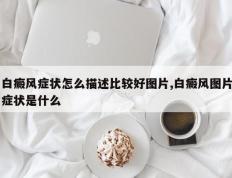 白癜风症状怎么描述比较好图片,白癜风图片症状是什么