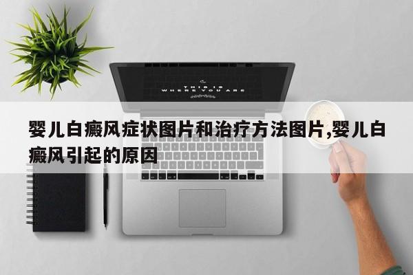 婴儿白癜风症状图片和治疗方法图片,婴儿白癜风引起的原因