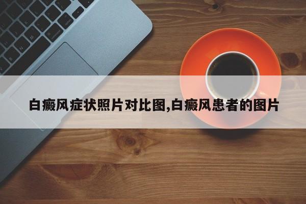 白癜风症状照片对比图,白癜风患者的图片