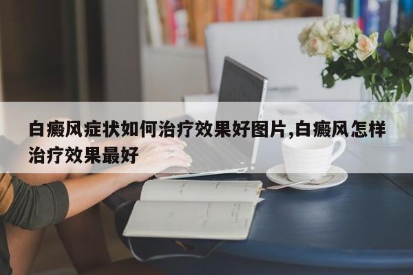 白癜风症状如何治疗效果好图片,白癜风怎样治疗效果最好